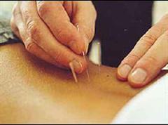 Bei der Untersuchung wurde auch eine Akupunktur vorgetäuscht - mit ähnlich guten Ergebnissen.